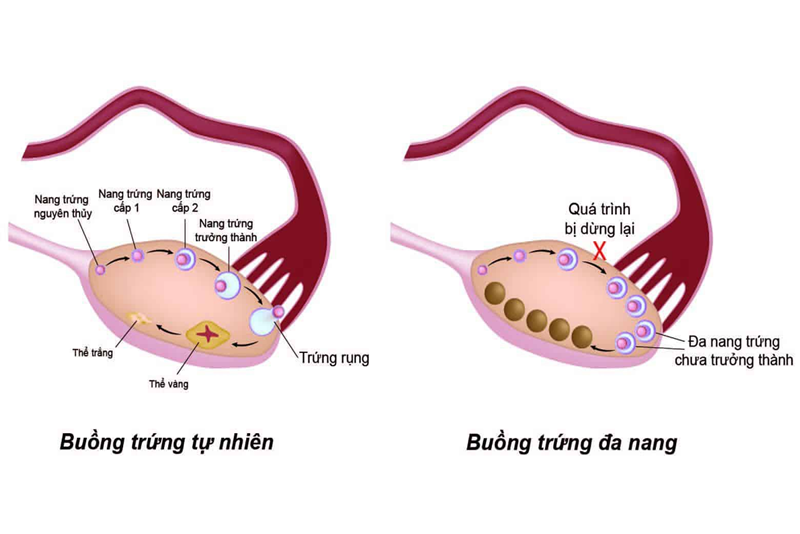 Buồng trứng đa nang có thể gây rụng tóc