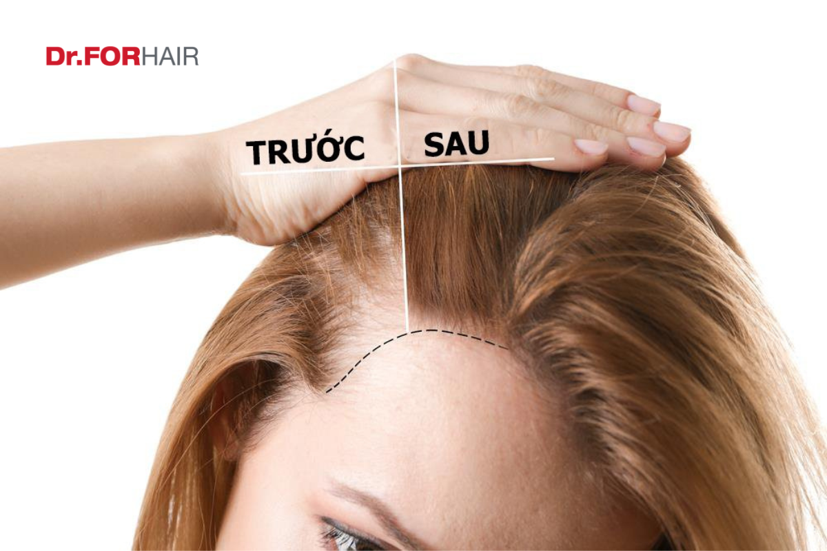 phục hồi tóc hư tổn