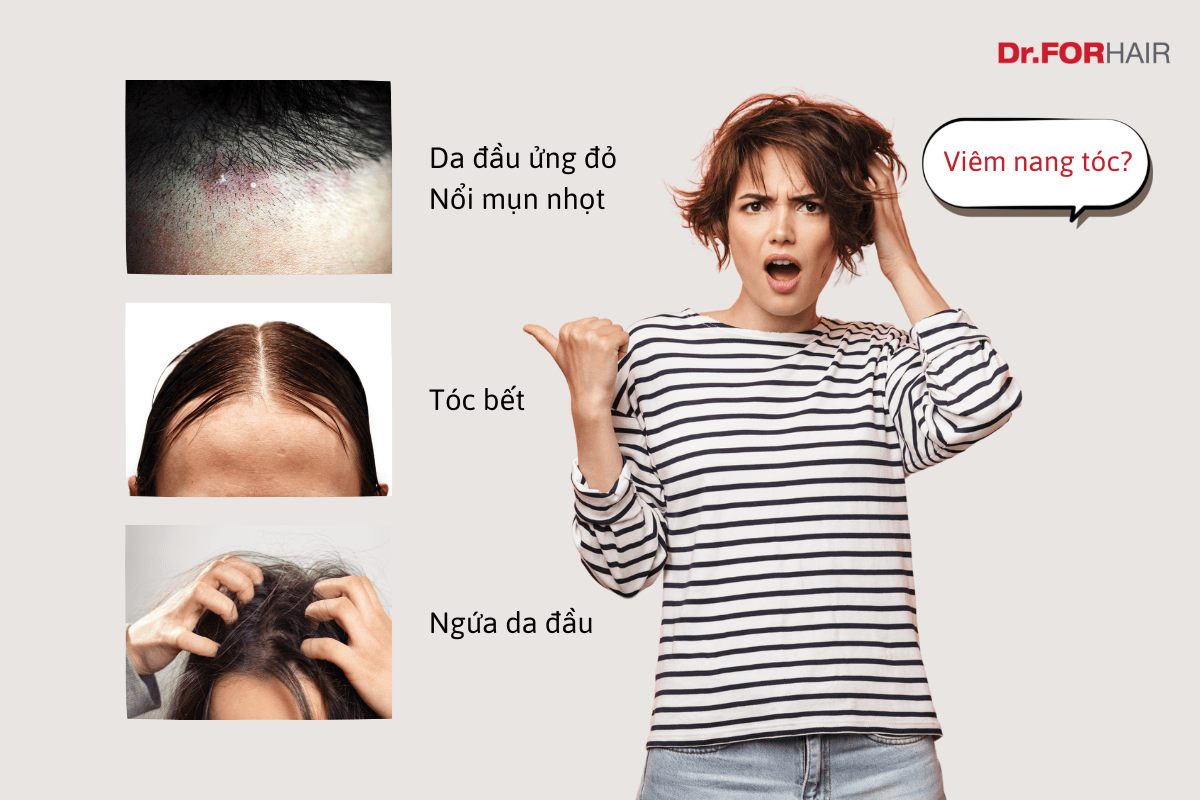 dầu gội dành cho da đầu nhờn
