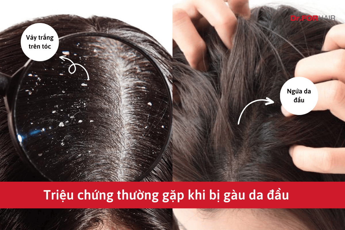 gàu da đầu