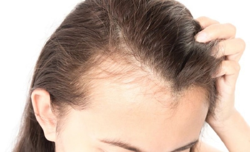 Tình trạng hói đầu khi còn trẻ tuổi